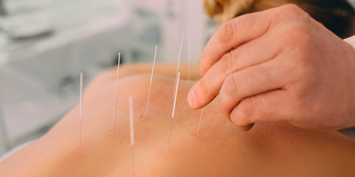 Acupuncture needles inserted into the back of patient