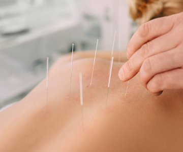 Acupuncture