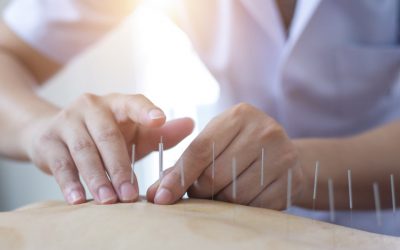 blog-image-acupuncture-1200x600 Acupuncture needles inserted into back of patient