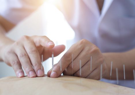 Acupuncture needles inserted into back of patient