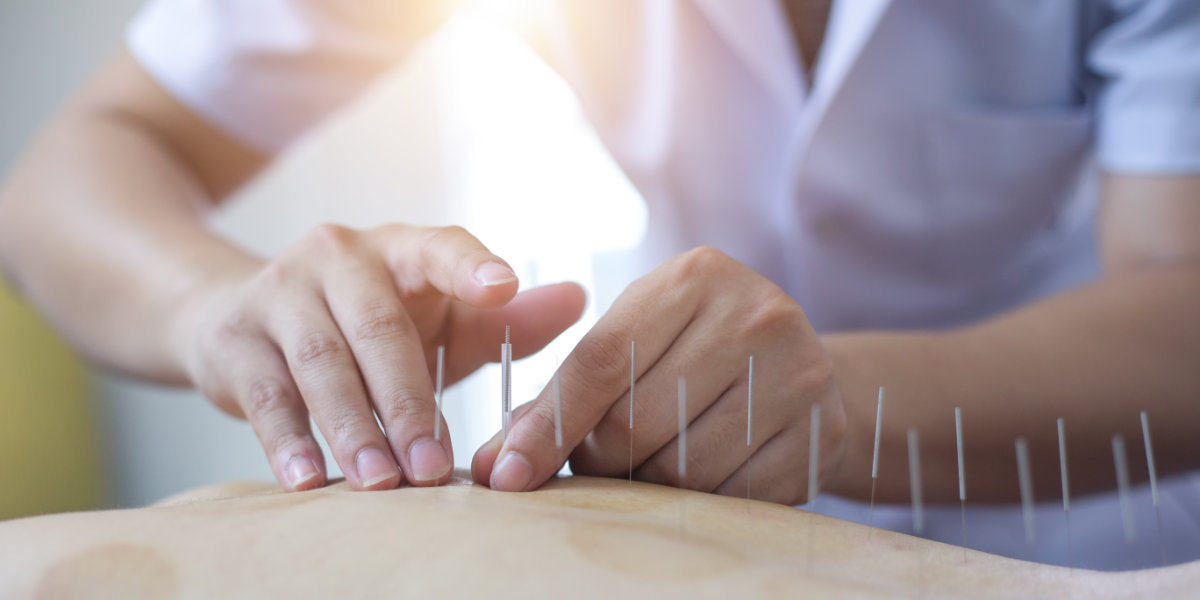 Acupuncture needles inserted into back of patient